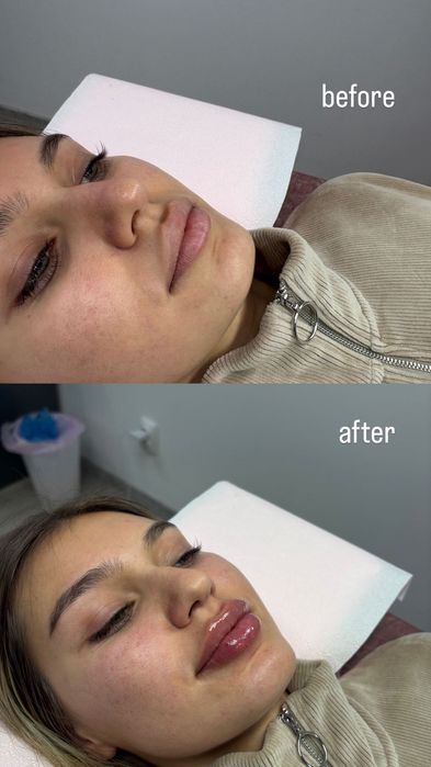 Buze perfecte cu Hyaluronpen