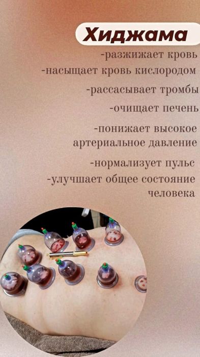 Хиджама - капиллярное кровопускание.