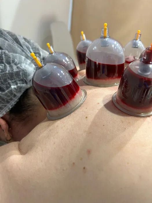 Хиджама и пиявки Астана