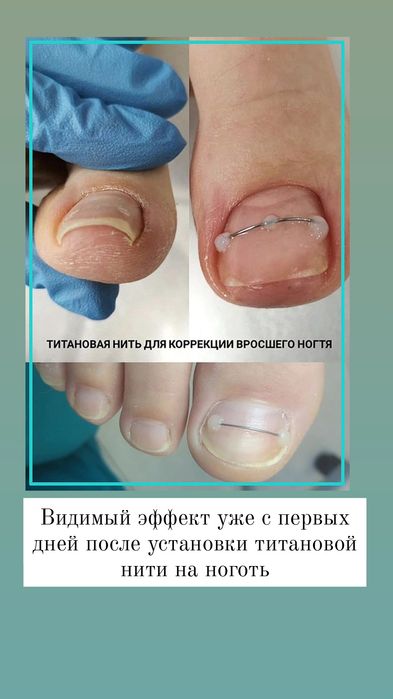 Педикюр титановая нить подолог