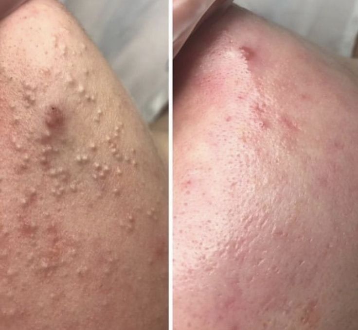 Врач Дерматолог-Косметолог |Чистка лица | Профессиональные процедуры