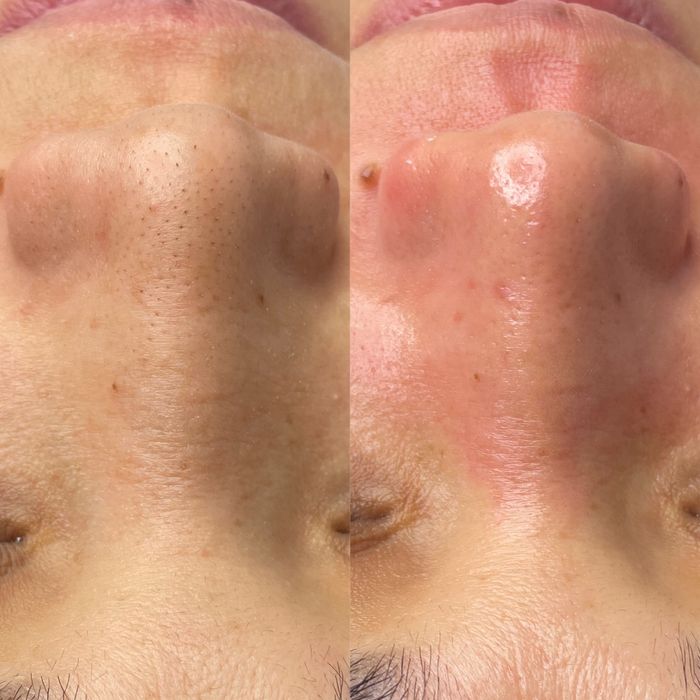 Чистка лица по акции