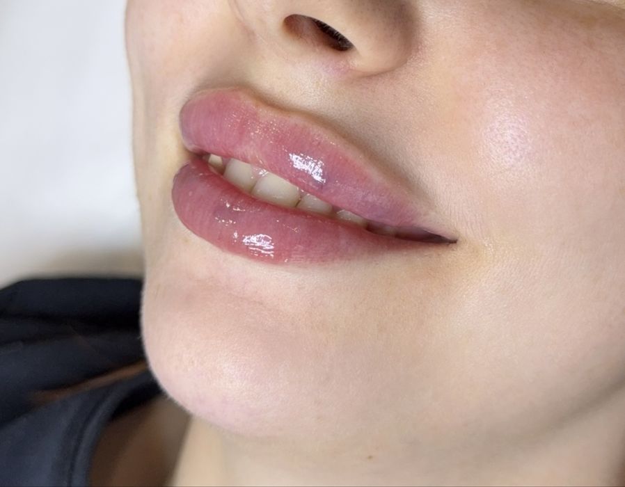 Увеличение губ | Ташкент | Натуральный результат