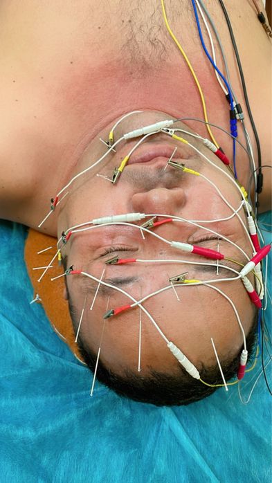 Обучение иглотерапии