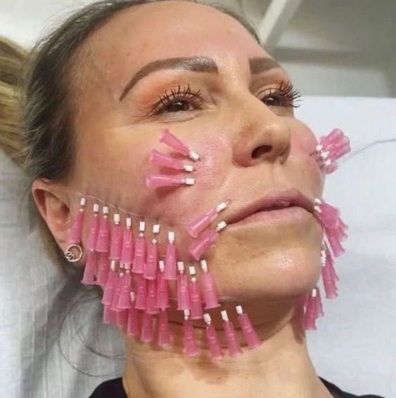 Лабга филлер ботекс