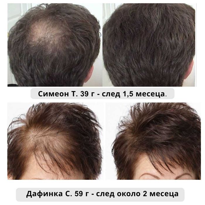 крем против алопеция