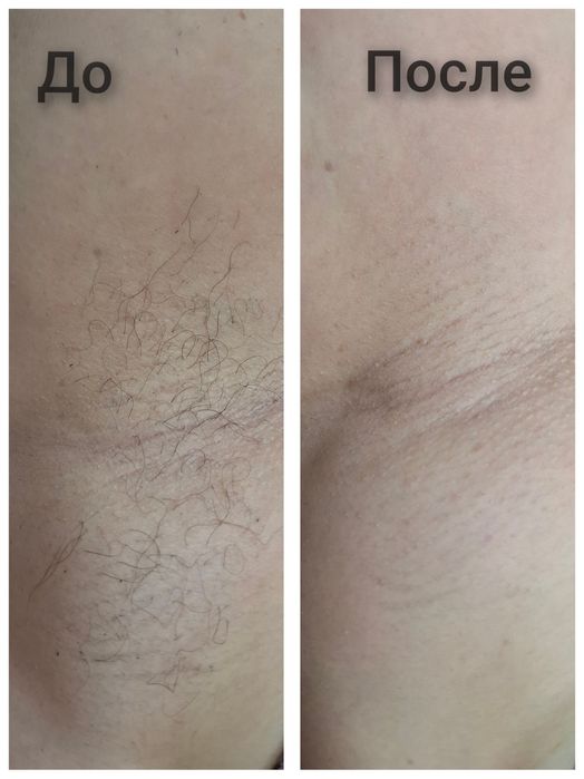 Восковая депиляция Итальянским и Китайским воском