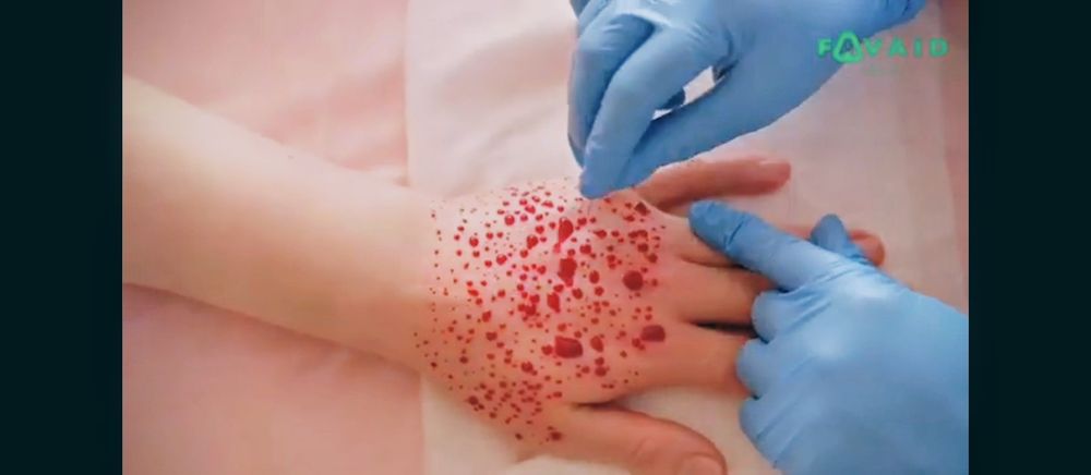 Хиджама, лечение пиявками массаж