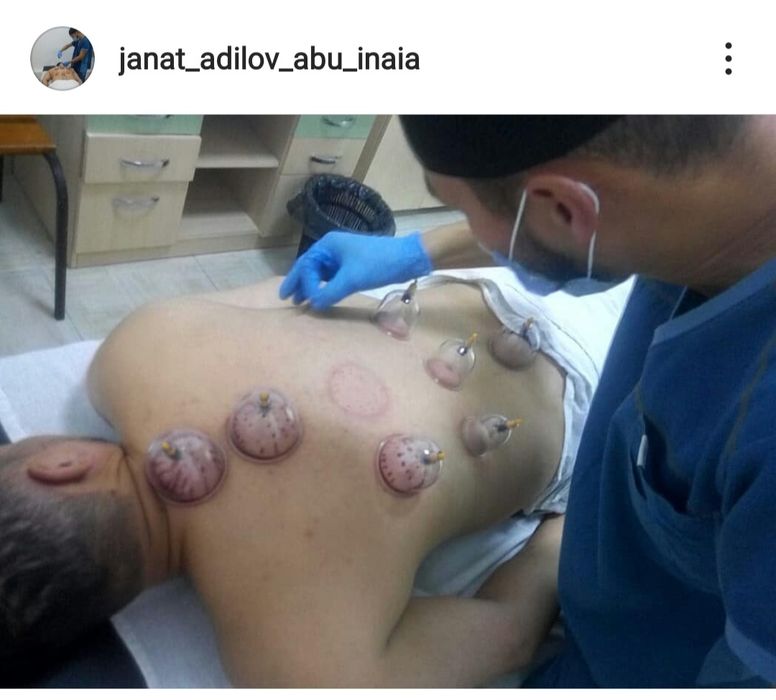 Кровопускание Хиджама Павлодар