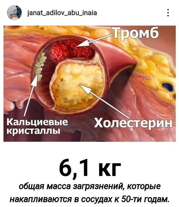 Кровопускание Хиджама Павлодар