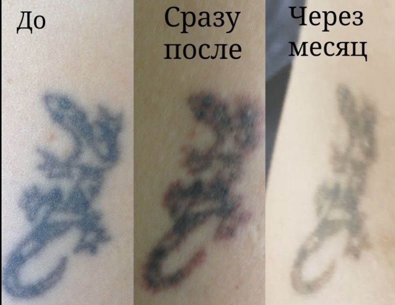 Удаление татуажа и татуировок