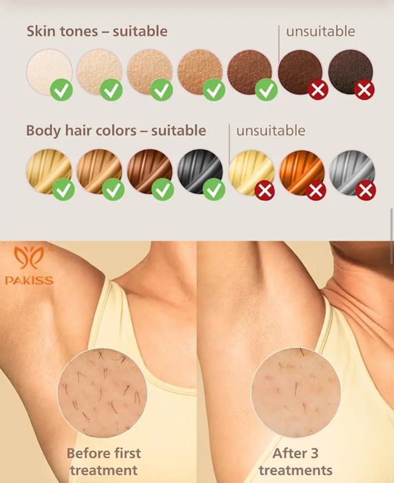 (Sf-70) Аппарат для лазерной эпиляции IPL для женщин