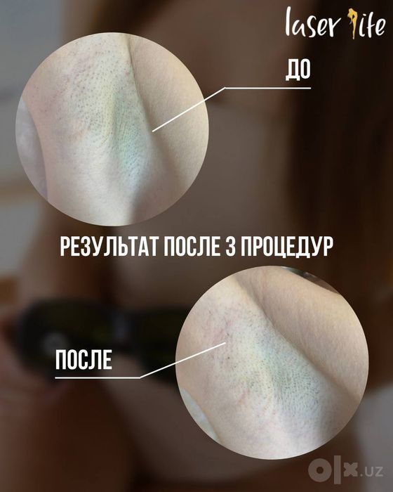 Лазерная эпиляция