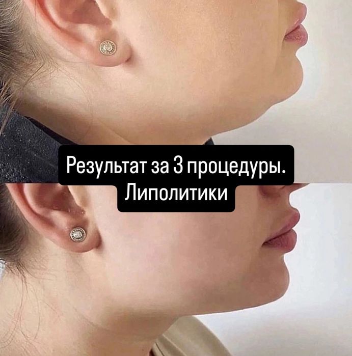 Скидки на ботокс! Диспорт (DYSPORT)