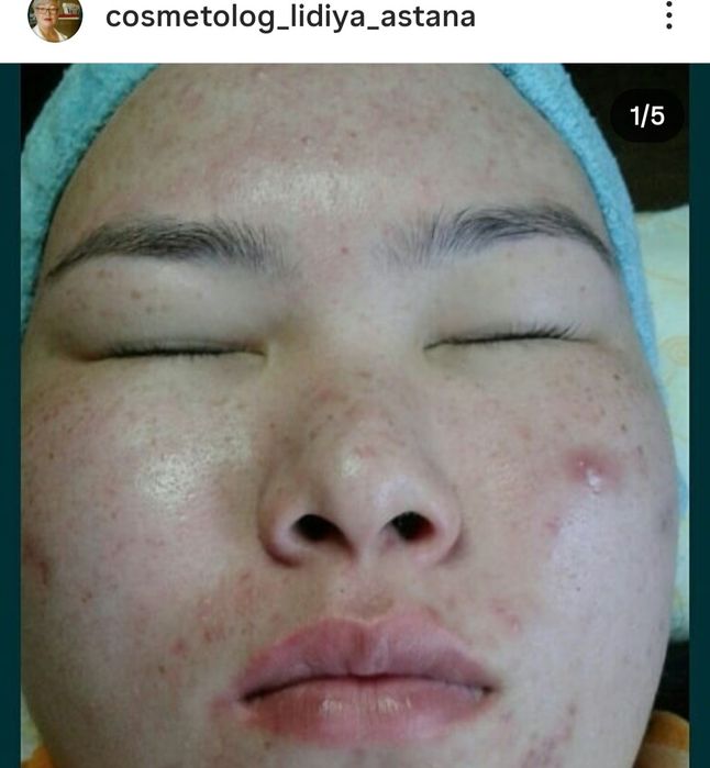 ЧИСТКА ЛИЦА от 7000.