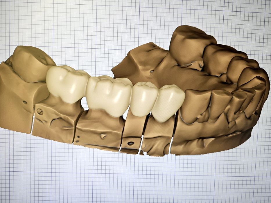 Дигитален Дизайн на Зъбопротезни конструкции от Зъботехник чрез Exocad