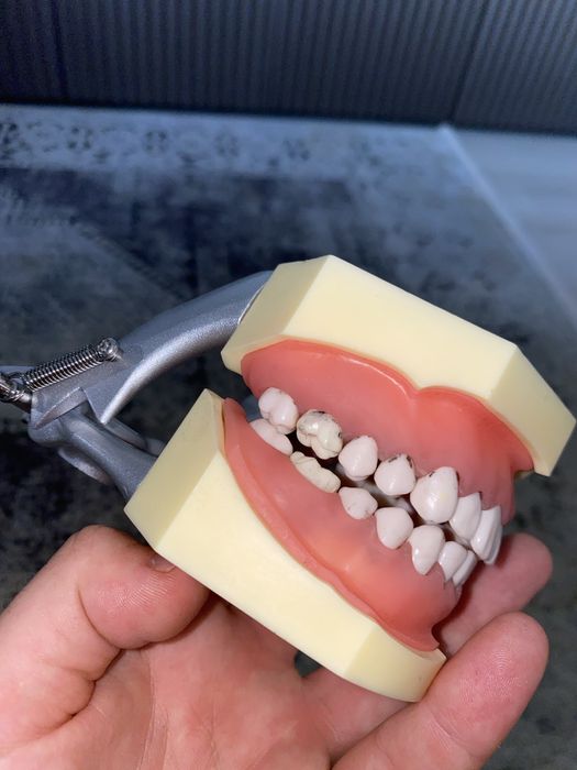 Arcadă dentară cu boală parodontală și tartru