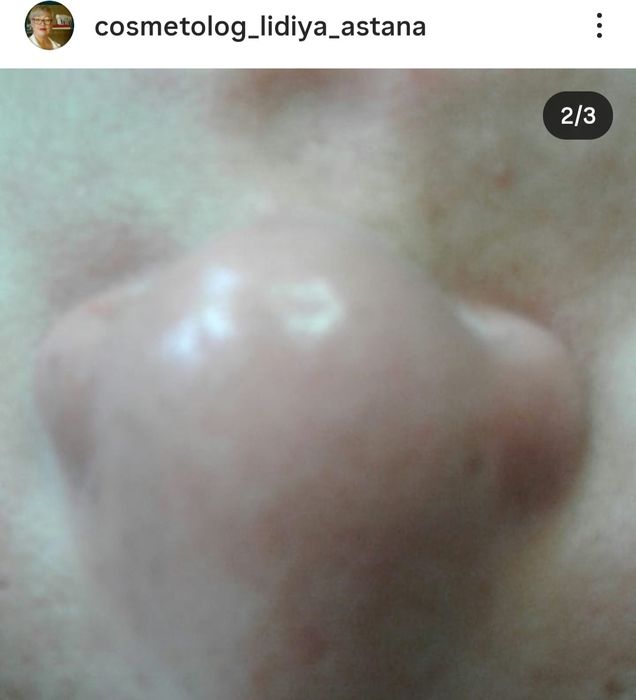 ЧИСТКА ЛИЦА от 7000.