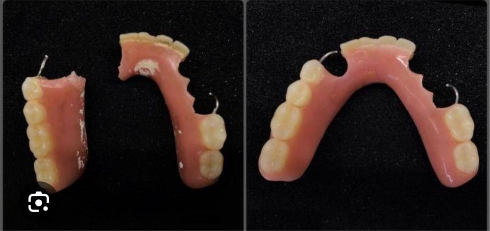 Протез ремонт пачинка