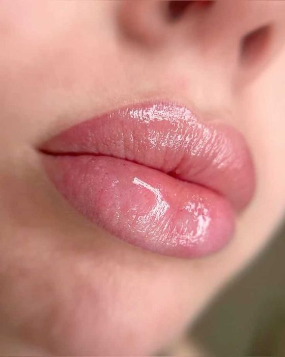 Увеличение Губ наполнение носогубки