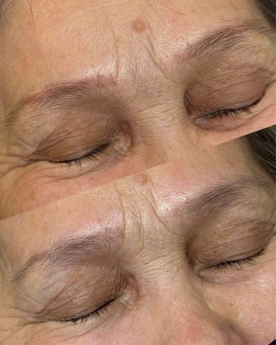 Лазерное удаление татуажа