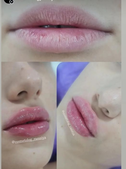 Губы, Ботокс, Филлеры