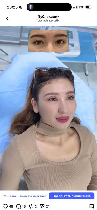-50% CHEGIRMADA Qovoqlar Blefaroplastikasi