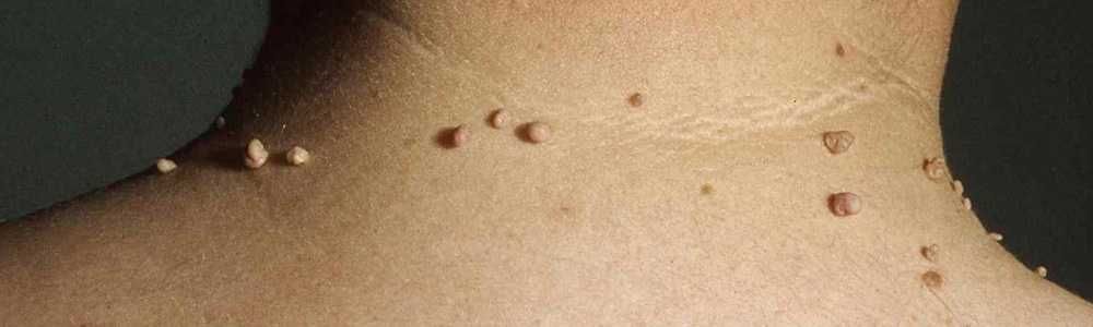 Удаление папиллом, электрокоагуляция и лазер. Papilloma yo'qotish.