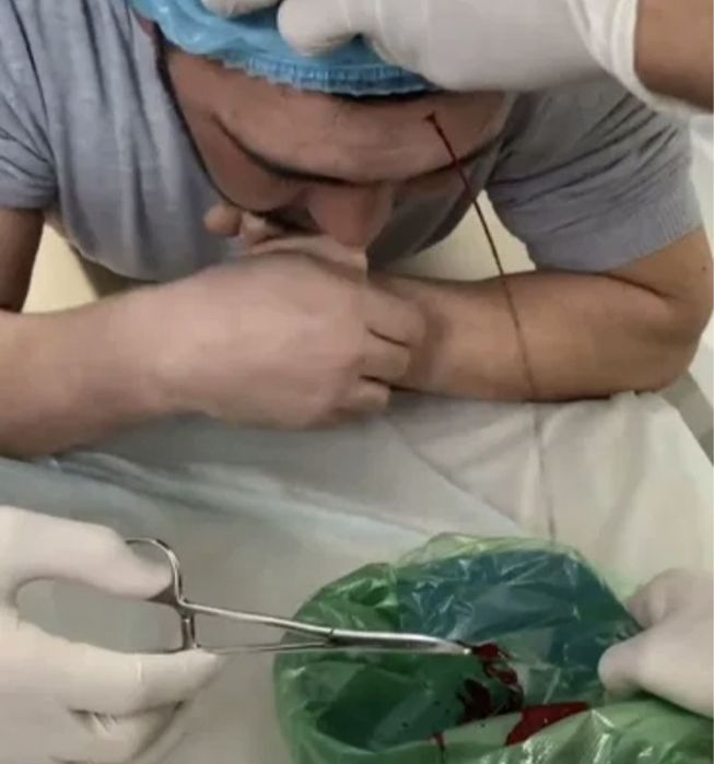 Хиджама. Кровопускание. Шертпе