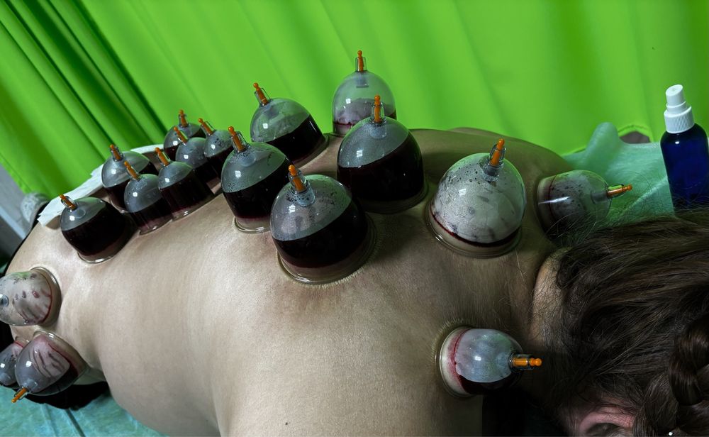 Лечебный массаж, хиджама