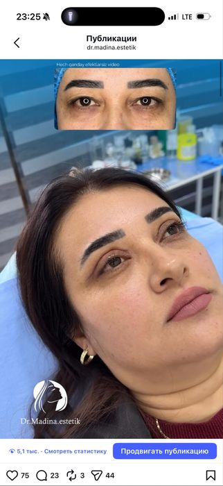 -50% CHEGIRMADA Qovoqlar Blefaroplastikasi