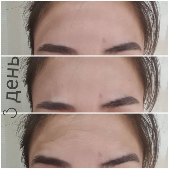 Ботокс | Косметолог Ташкент |