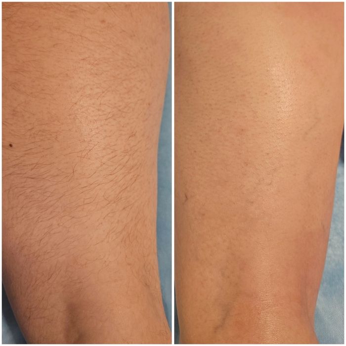 Epilare femei și bărbați, tratament cu parafina mâini și picioare