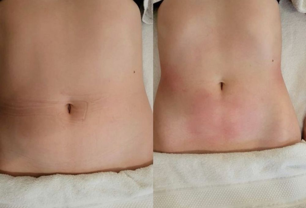 Шугаринг всего тела