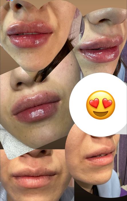 Губы, Ботокс, Филлеры