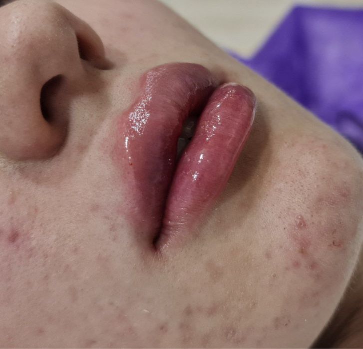 Губки , филлер, ботокс . Качественно!