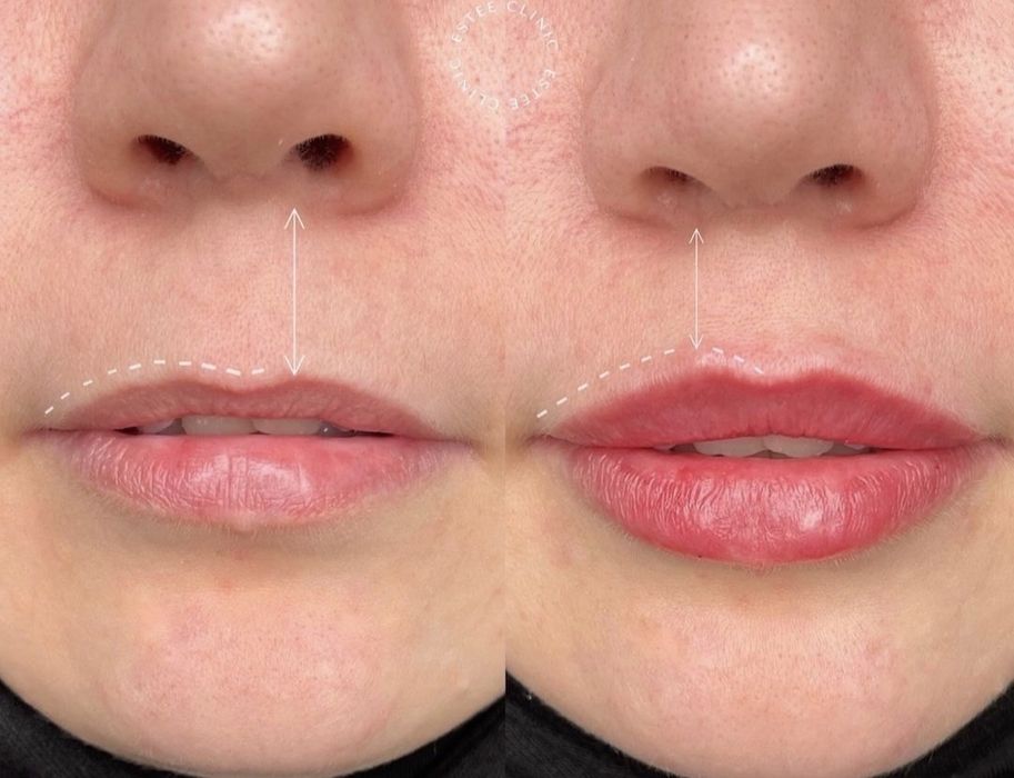 Акция Увелечение губ