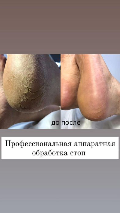 Педикюр титановая нить подолог