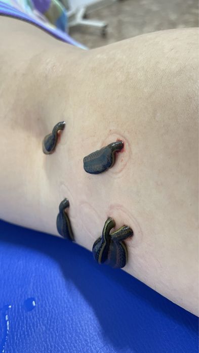 Лечение пиявками, сүлікпен емдеу