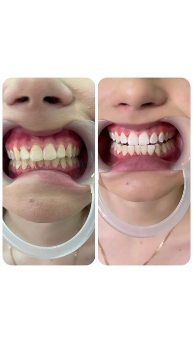 Отбеливание зубов