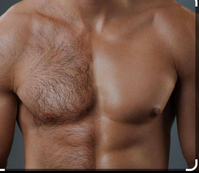 Депиляция Эпиляция лазерная мужской