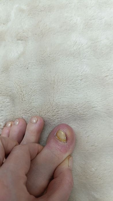 Лечение и исправление вросших ногтей.  Падолог