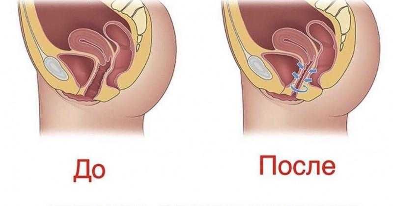 Интимное омоложение. Безоперационное лазерное интимное сужение.