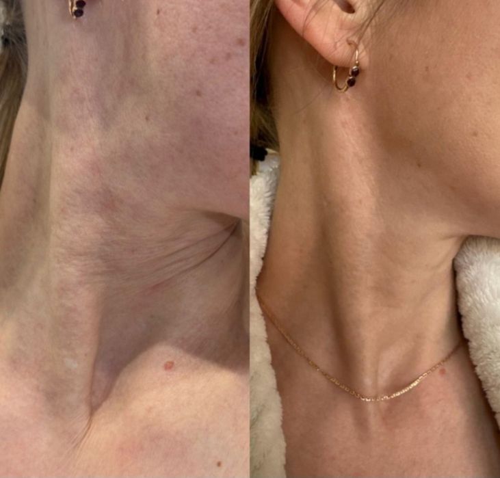 Коллагенотерапия.  Лицо, шея, декольте