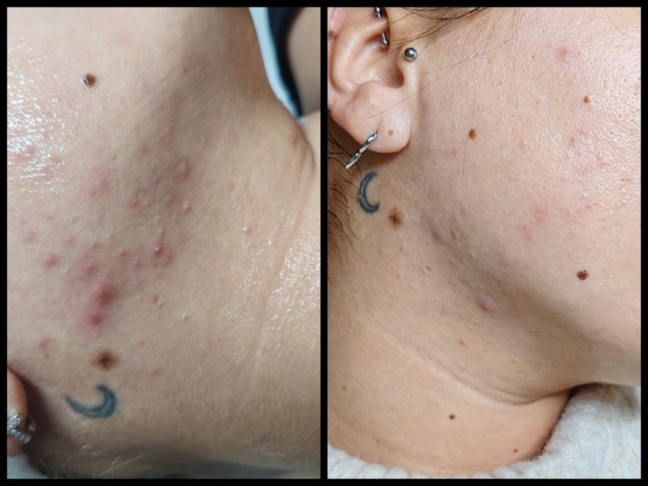 DOAR FEMEI!!! Epilat FEMEI cu ceara de unica folosința,Ep. Definitiva