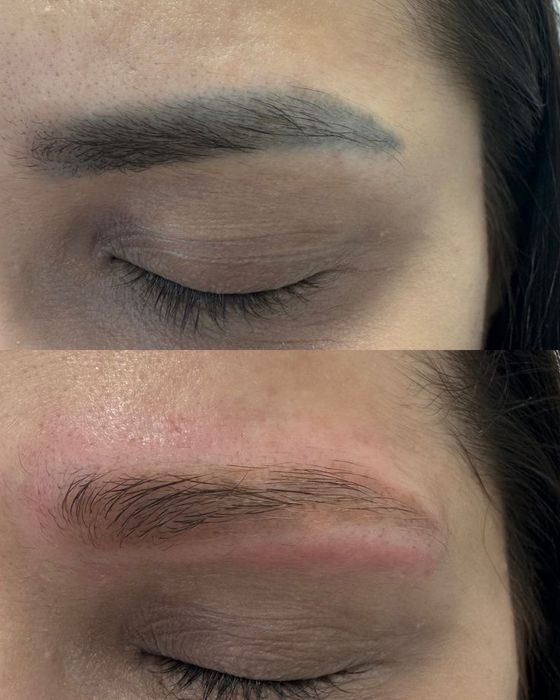 Лазерное удаление татуажа 5000