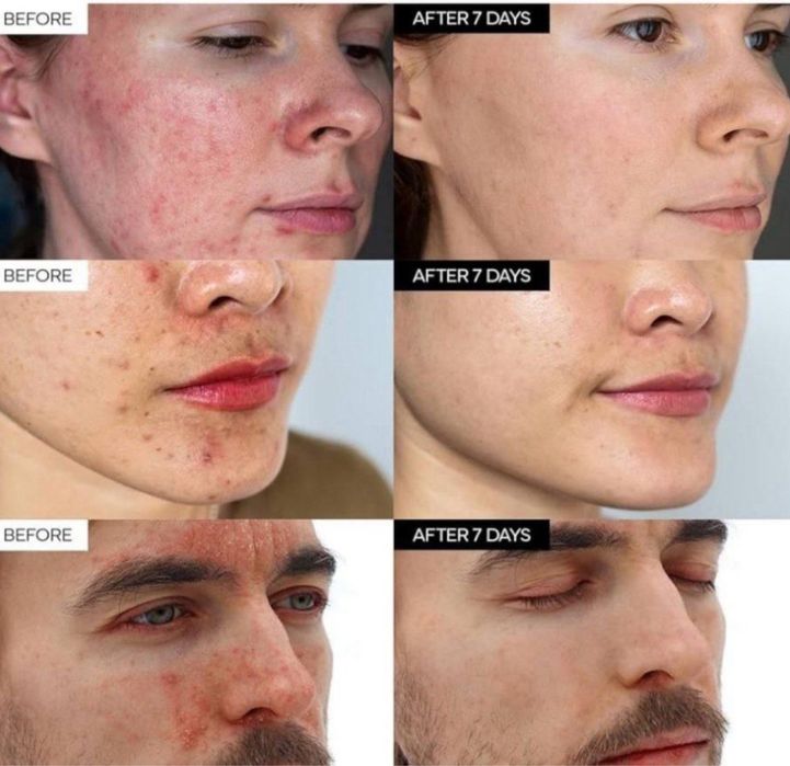 Yuz kremi,akne,toshmalar,doglar,крем,husnbuzar,7 kunda sezirarli natij