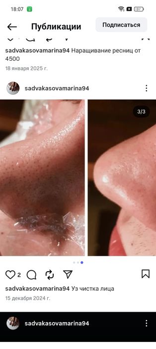 + Подарок УЗ чистка
Чистка Прок
Ппрг