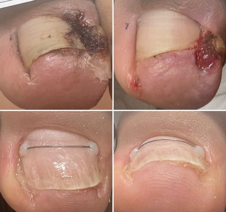 Подология лечение стоп и ногтей