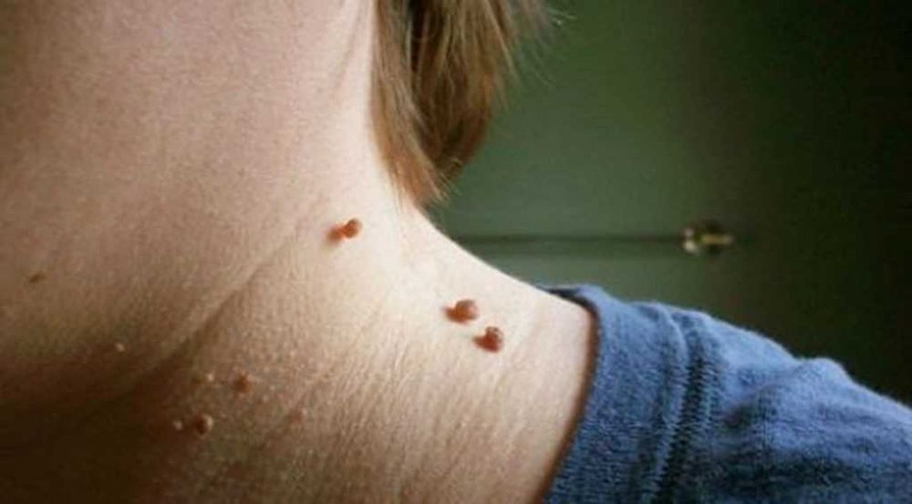 Лазерное удаление папиллом и бородавок на дому, в клинике коагулятором